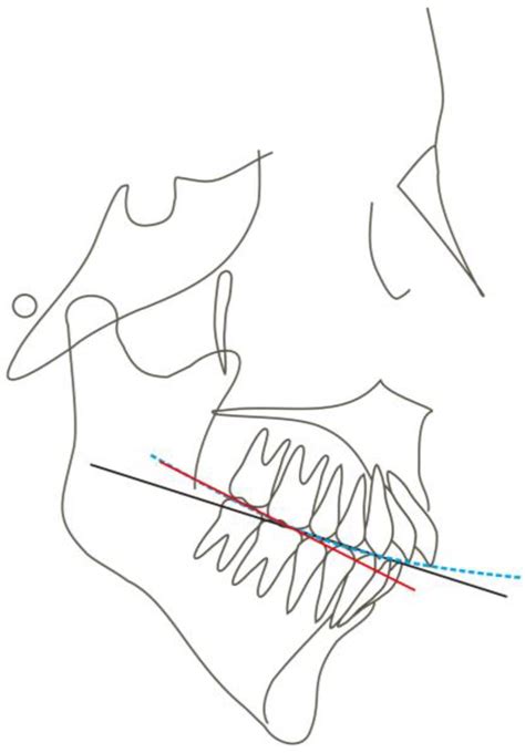 Medicina Free Full Text Vertical Control Of A Severe Hyperdivergent Skeletal Class Ii