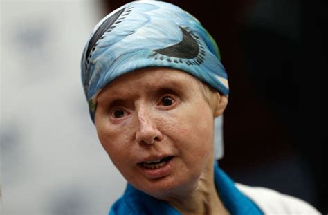 Charla Nash Opens Up About Recent Face Transplant Setback Living