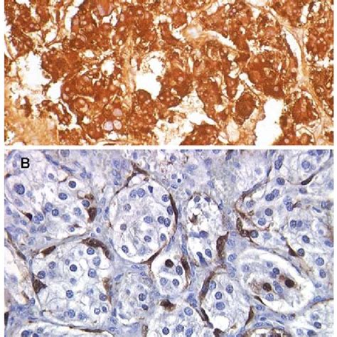 A Strong Reactivity With Chromogranin Staining By Immunohistochemical