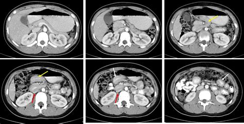 Midgut volvulus – Radiology Cases