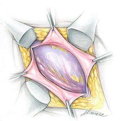 Hernia Repair Surgery Technique - Surgical Tour (Panel 2) - Hernia ...