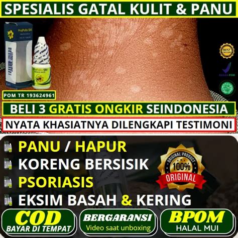 Obat Spesialis Panu Hapur Yang Baik Untuk Anak Dan Dewasa Penghilang