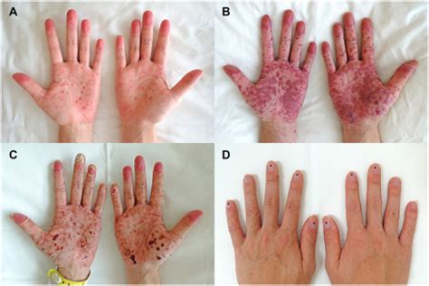 Adult Hand Foot And Mouth Disease The American Journal Of Medicine