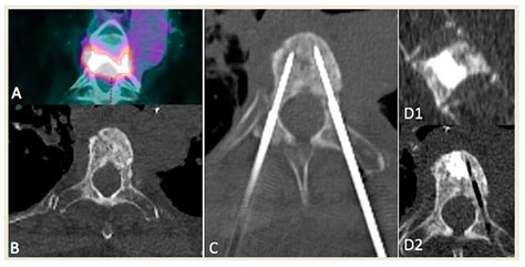 Medicina Free Full Text Bipolar Radiofrequency Ablation Of Painful