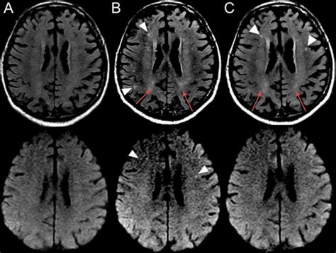 MRI Findings Of A 74 Year Old Man With CHIKV Associated Encephalitis