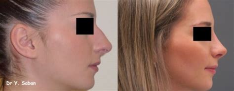 Le Boom De La Rhinoplastie Conservatrice Ou Comment Refaire Son Nez