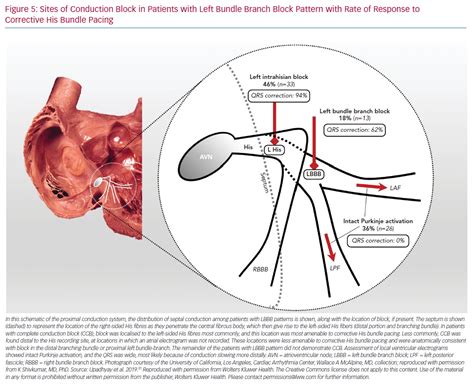 Bundle Branch Block Measurement