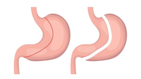 Understanding Sleeve Gastrectomy Surgery A Path To Weight Loss