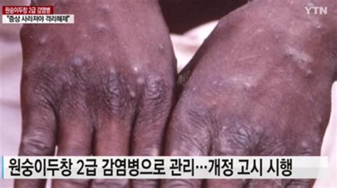 ‘원숭이두창 감염 환자 발생 국내 두 번째“현재 경증 상태 양호” 뉴스인사이드