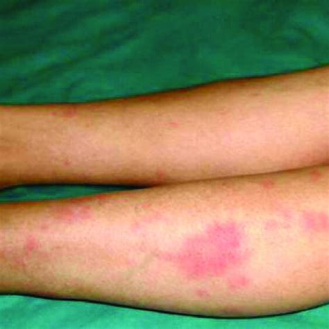 Typical Eruption Of Erythema Nodosum Along The Top Surfaces Of The