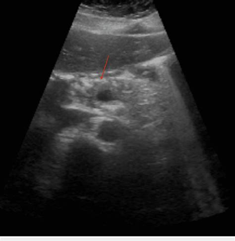 Ultrasound With Hypoechoic Pancreas Consistent With Acute Pancreatitis