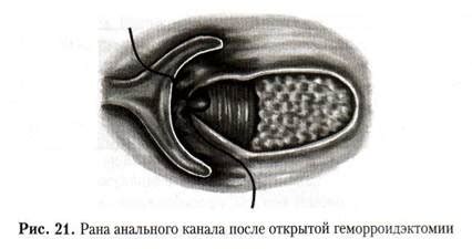 ГЕМОРРОЙ