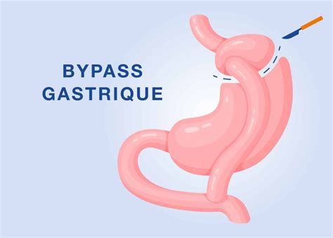 Bypass gastrique à Paris IOPC Institut de l obésité Paris Centre