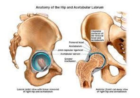 Acetabular Labral Tear