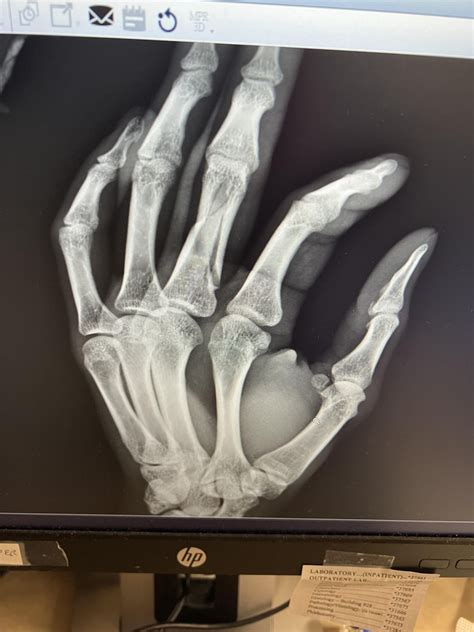 Complete Spiral Fracture Rhadtohurt