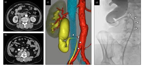 A D Abdominal Enhanced Ct Early Phase A And Ct Urography B White Download Scientific