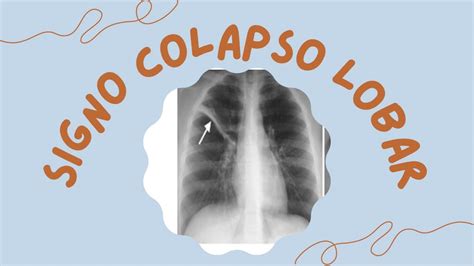 Atelectasia Pulmonar Signos Radiologicos Tele De TÓrax Youtube