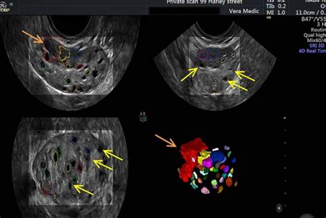 Ovarian Egg Assessment Private Ultrasound Scans London