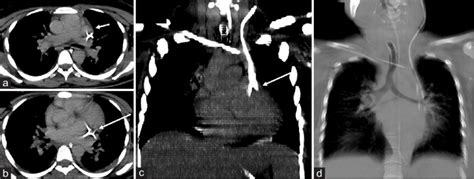 Contrast Enhanced Computed Tomography Chest Axial A And B And