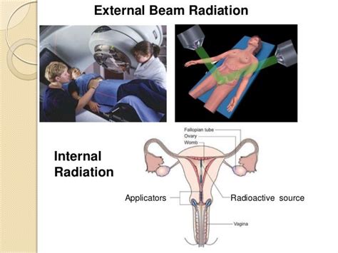 Radiation For Cervix Cancer