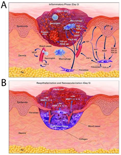 A A Cutaneous Wound 3 Days After Injury Growth Factors Thought To Be