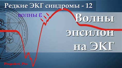 Эпсилон волна на ЭКГ. - YouTube