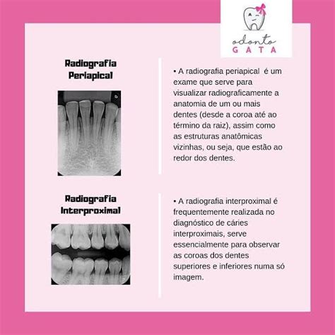 radiografia periapical x radiografia interproximal - Radiologia Pediatrica