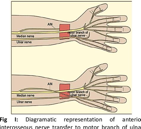 Figure I From Functional Outcome Of Anterior Interosseous Nerve