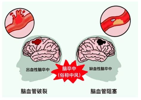 世界卒中日，早一秒挽救大脑 国家老年疾病临床医学研究中心中文版