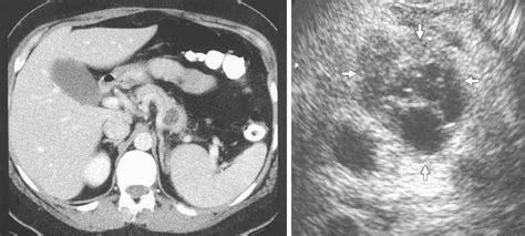 Incidental Pancreatic Cysts Gastroenterology Jama Surgery The