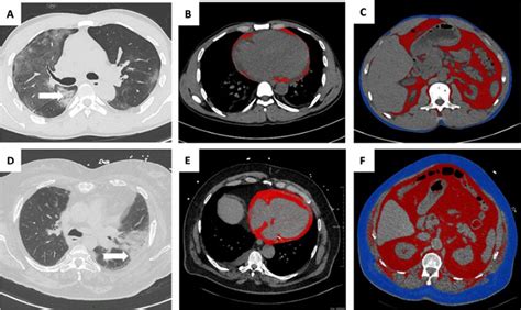 Illustration of CT imaging biomarkers assessed in two patients admitted ...