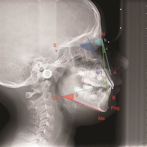 Sella Measurements Ds Dorsum Sellae Ts Tuberculum Sellae A Download Scientific Diagram