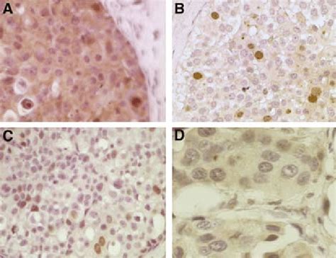 Immunohistochemical Staining For Surviving A Cytoplasmic Survivin