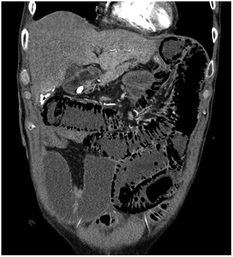 Computed Tomography Findings Small Bowel Distension Pneumatosis