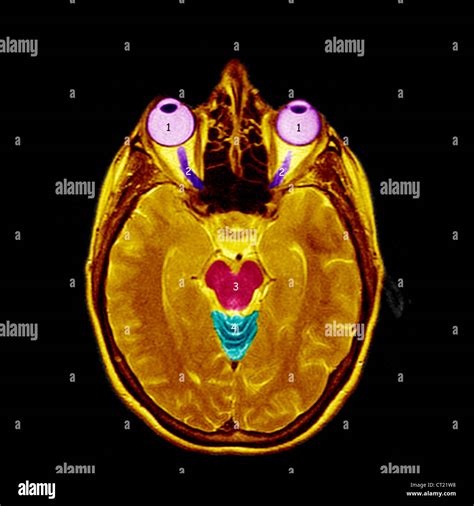 Optic nerve mri hi-res stock photography and images - Alamy