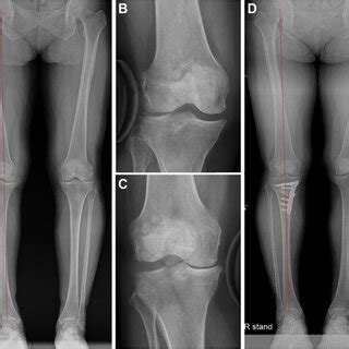 A 54 Year Old Female Patient Who Underwent Opening Wedge High Tibial