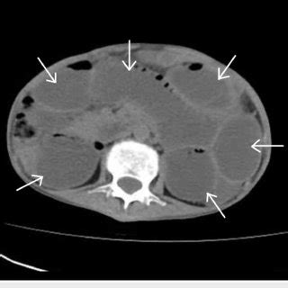 Preoperative Axial Computed Tomography Ct Scan Of The Abdomen Showing