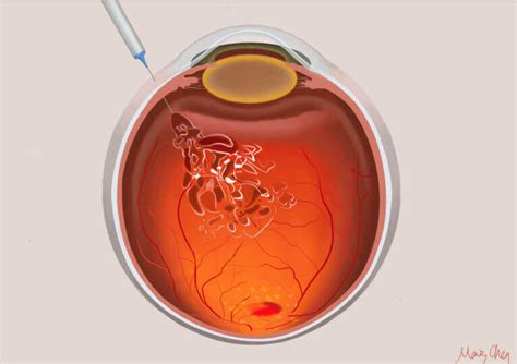 Anti Vegf Intravitreal Injection