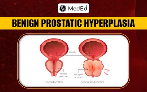 Benign Prostatic Hyperplasia Symptoms And Causes