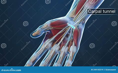 Carpal Tunnel Syndrome Is When The Median Nerve Is Compressed As It