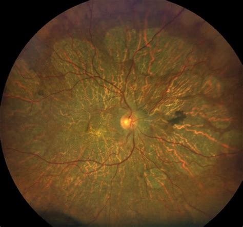 Thioridazine Toxicity Retina Image Bank