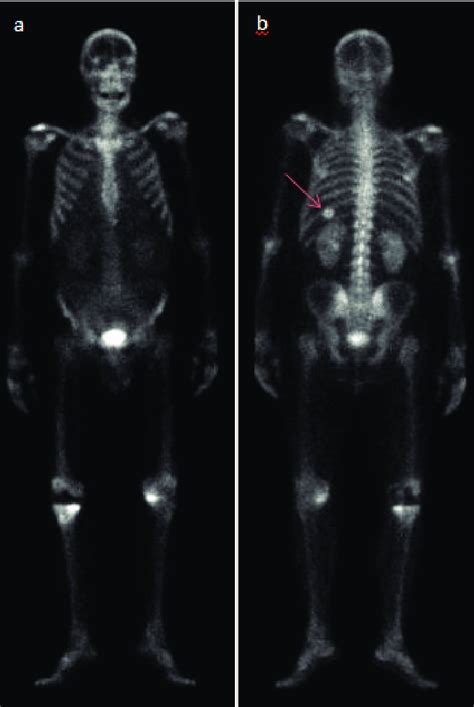 Bone Scan With 99m Tc Hdp Whole Body Anterior A And Posterior B