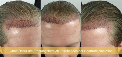 Haartransplantation Ohne Rasur Istanbul T Rkei Haare Transplantieren