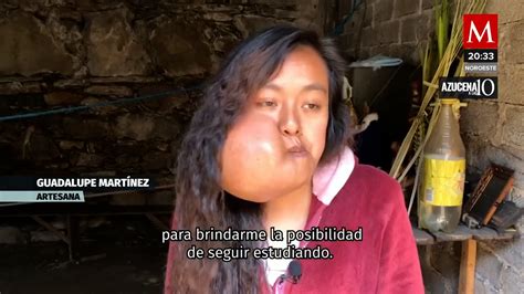 Le Niegan Atenci N M Dica A Joven De Oaxaca Por Tumor En La Mejilla