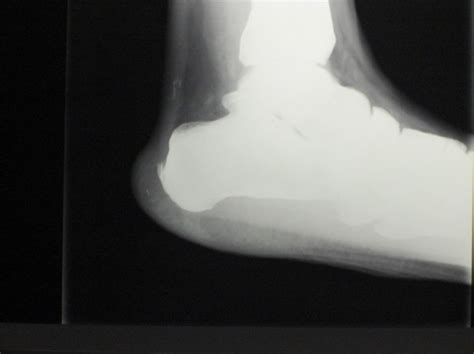 Insertional Calcific Tendinopathy Ct Of The Achilles Tendon Download Scientific Diagram