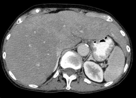 The CT scan – reduced hepatic perfusion in enlarged liver after ...