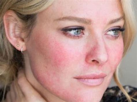 Rosacea Winter Time