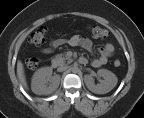 Normal Adrenal Glands Adrenal Case Studies Ctisus Ct Scanning