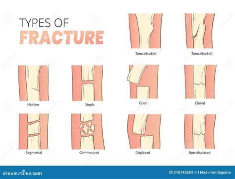 Types Of Bones Fractures Bones Fracture Classification Stock Vector