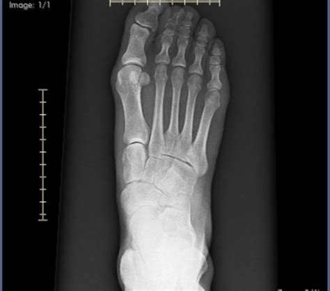 Finally saw a Dr. : r/bunions